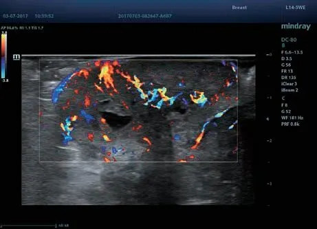 Клинические изображения УЗИ аппарат Mindray DC-80 Exp