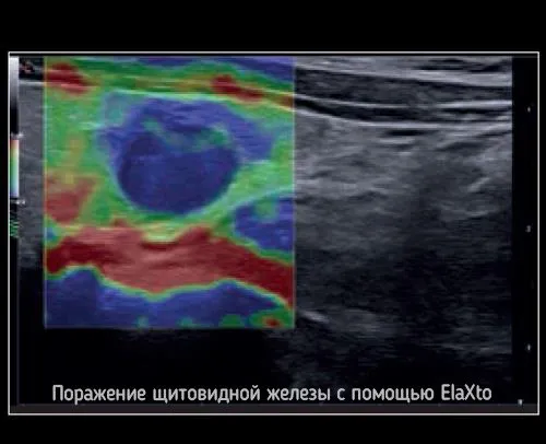 Клинические изображения УЗИ аппарат Esaote MyLab X8