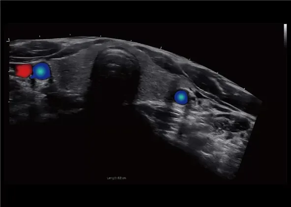 Клинические изображения УЗИ аппарат Chison CBit 9