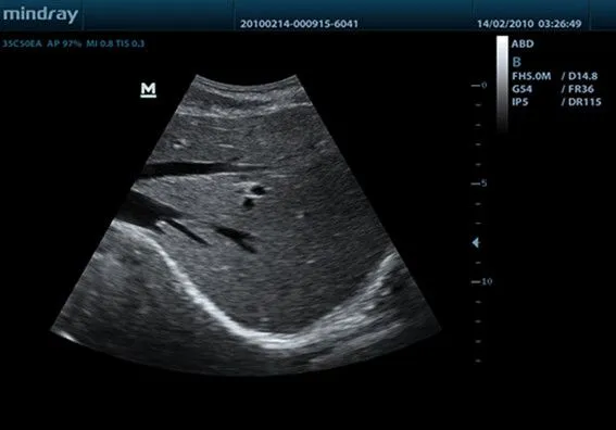 Клинические изображения УЗИ аппарат Mindray DP-50 портативный