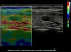Клинические изображения УЗИ аппарат Chison SonoTouch 80 портативный