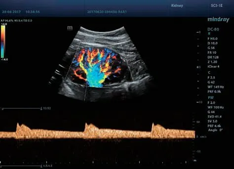 Клинические изображения УЗИ аппарат Mindray DC-80 Exp