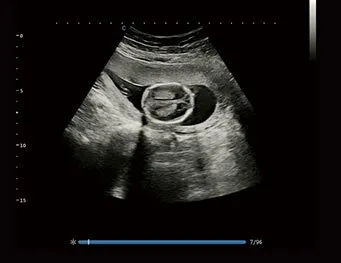 Клинические изображения УЗИ аппарат Chison XBit 80