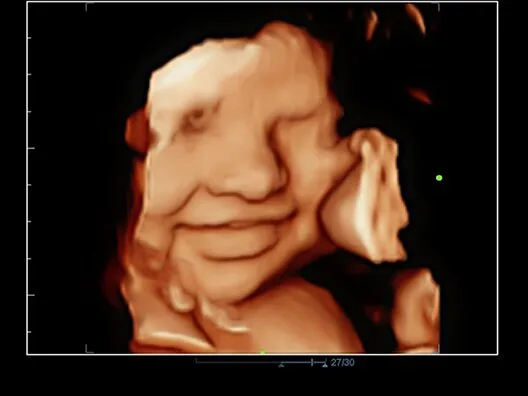 Клинические изображения УЗИ аппарат Mindray DC-70 Exp