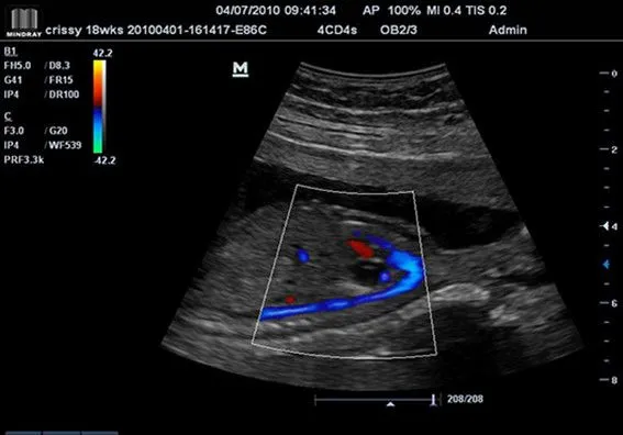Клинические изображения УЗИ аппарат Mindray DC-T6