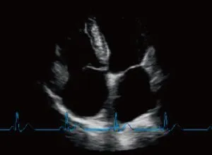 Клинические изображения УЗИ аппарат Chison SonoTouch 80 портативный