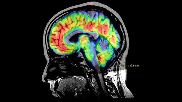 Клинические изображения МРТ аппарат GE SIGNA Explorer 1.5T