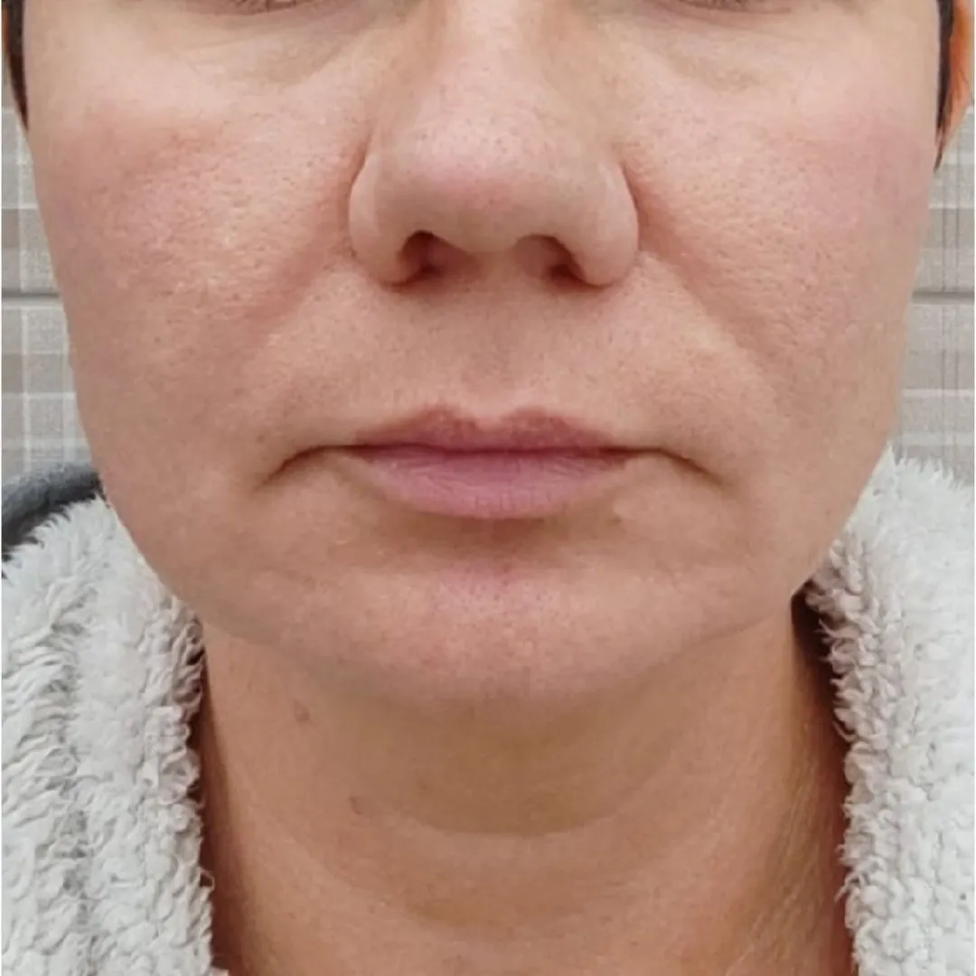 NeoGen омоложение анфас после.jpg