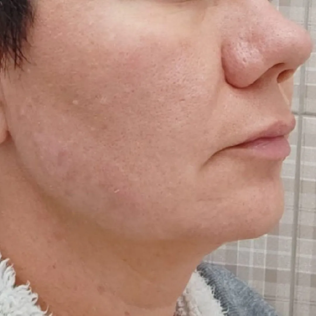 NeoGen омоложение право после.jpg