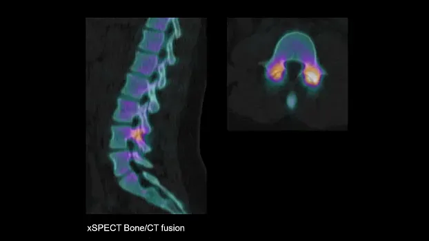 Клинические изображения Siemens Symbia Intevo Bold КТ аппарат 