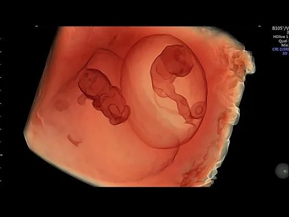 Клинические изображения УЗИ аппарат GE HealthCare Voluson E8 