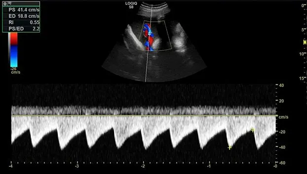 Клинические изображения GE Logiq S8 XDclear ультразвуковая диагностическая система