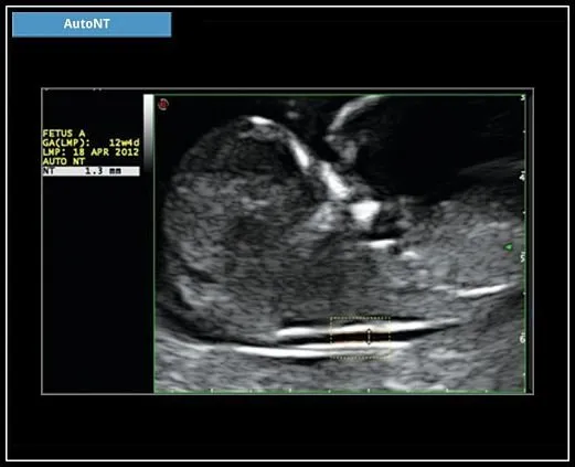 Клинические изображения УЗИ аппарат Esaote MyLab X6