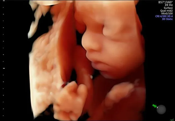 Клинические изображения УЗИ аппарат GE HealthCare Voluson S10