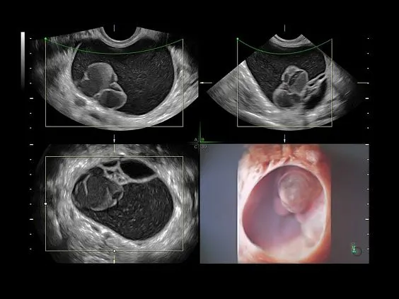 Клинические изображения УЗИ аппарат GE HealthCare Voluson E8 