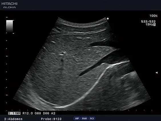 Клинические изображения УЗИ аппарат Fujifilm (Hitachi) Aloka ProSound F31