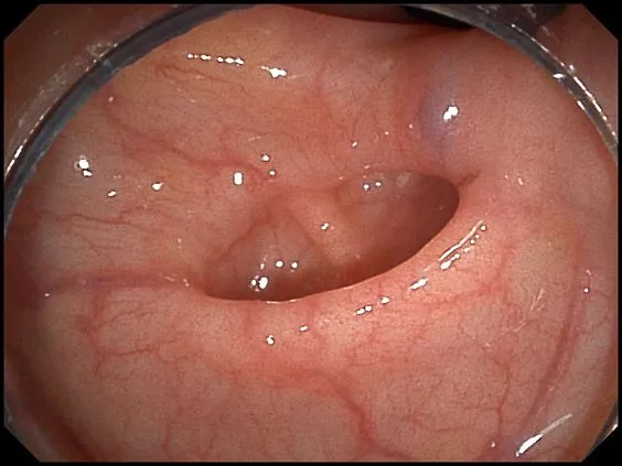 Клинические изображения SonoScape HD-500 видеоэндоскопическая система