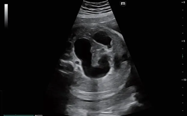 Клинические изображения УЗИ аппарат Mindray Imagyn I9