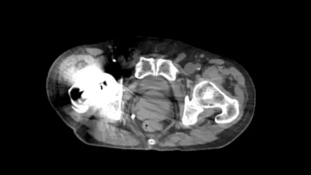 Клинические изображения Siemens SOMATOM go.Sim компьютерный томограф 