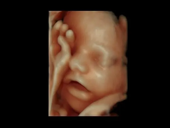 Клинические изображения Ультразвуковая диагностическая система GE Voluson E10