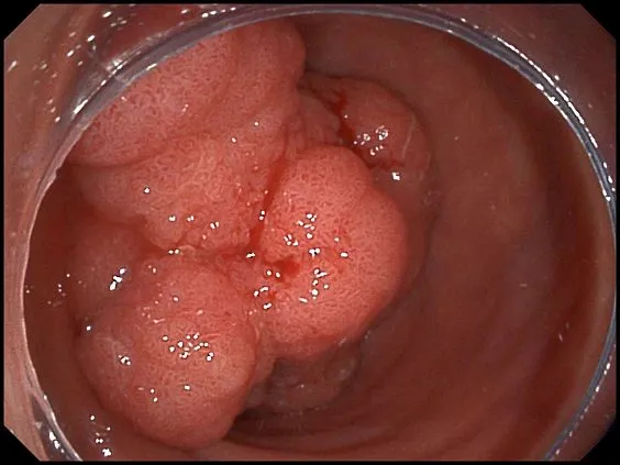 Клинические изображения SonoScape HD-320 видеоэндоскопическая система