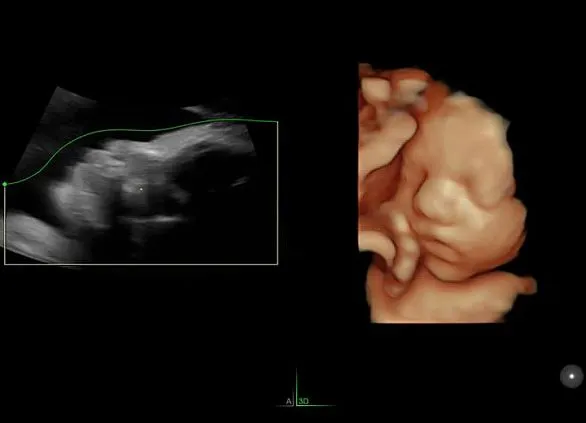 Клинические изображения Ультразвуковая диагностическая система GE HealthCare Voluson E6