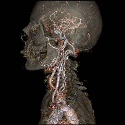 Клинические изображения GE HealthCare Revolution CT компьютерный томограф