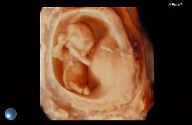 Клинические изображения Canon (Toshiba) Aplio 500 УЗИ аппарат