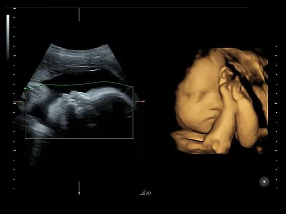Клинические изображения GE Voluson S8 ультразвуковой аппарат