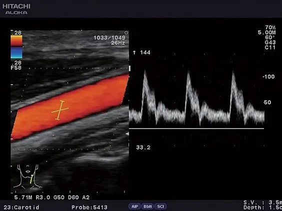 Клинические изображения УЗИ аппарат Fujifilm (Hitachi) Aloka ProSound F31