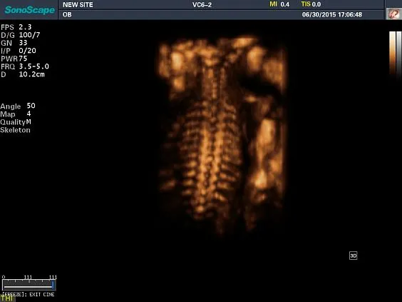 Клинические изображения Sonoscape S8 Exp ультразвуковой аппарат