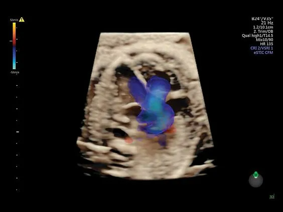 Клинические изображения Ультразвуковая диагностическая система GE Voluson E10