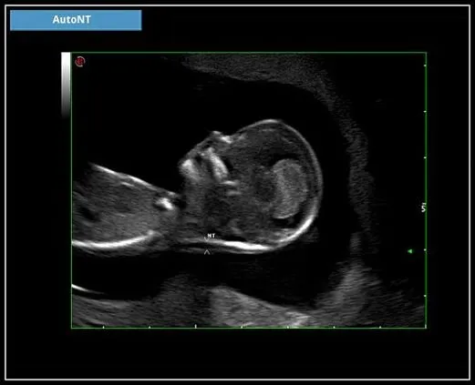 Клинические изображения УЗИ аппарат Esaote MyLab X5