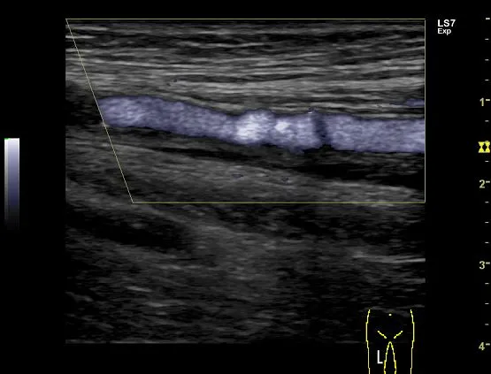 Клинические изображения Ультразвуковая диагностическая система GE Logiq S7 XDclear