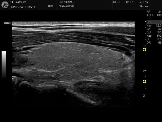 Клинические изображения GE HealthCare Logiq P10 ультразвуковой аппарат