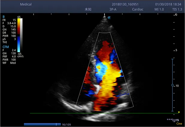 Клинические изображения Ультразвуковой аппарат Sonoscape S2N
