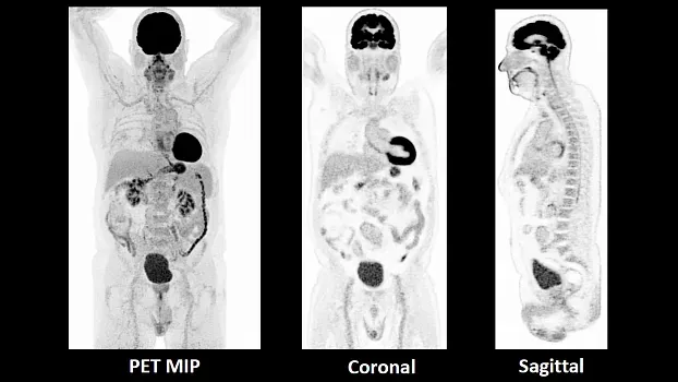 Клинические изображения Siemens Biograph Vision ПЭТ-КТ