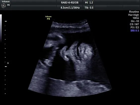 Клинические изображения УЗИ аппарат GE HealthCare Voluson P8