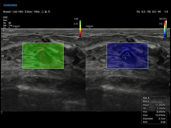 Клинические изображения Samsung Medison V7 УЗИ аппарат