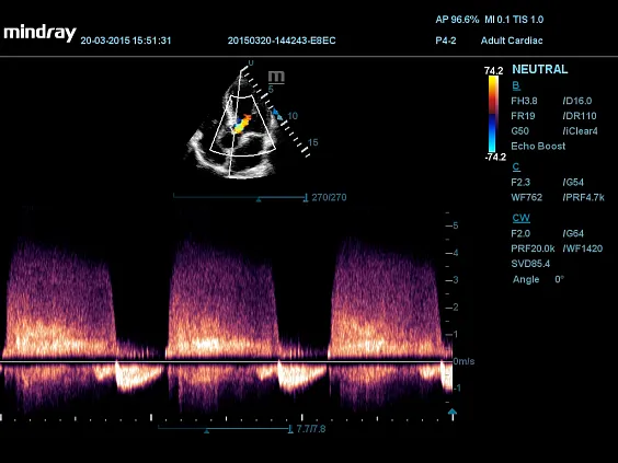 Клинические изображения УЗИ аппарат Mindray DC-60 Exp