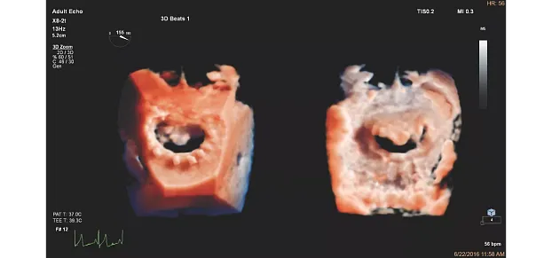 Клинические изображения Philips EPIQ CVx ультразвуковой аппарат