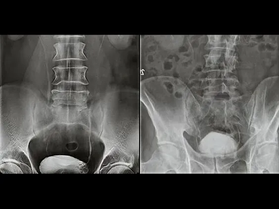 Клинические изображения Цифровой рентгенографический аппарат GE Discovery XR656 HD