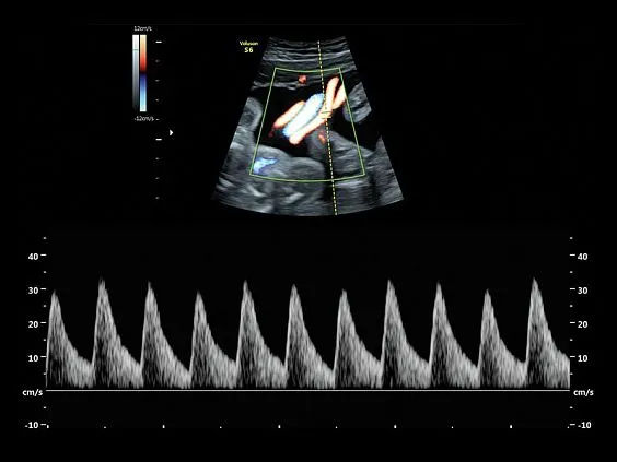 Клинические изображения GE Voluson S6 аппарат УЗИ