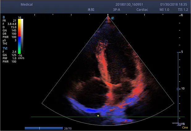 Клинические изображения Ультразвуковой аппарат Sonoscape S2N