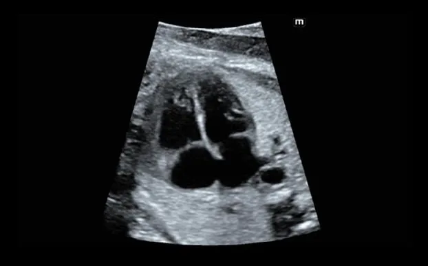 Клинические изображения УЗИ аппарат Mindray Imagyn I9