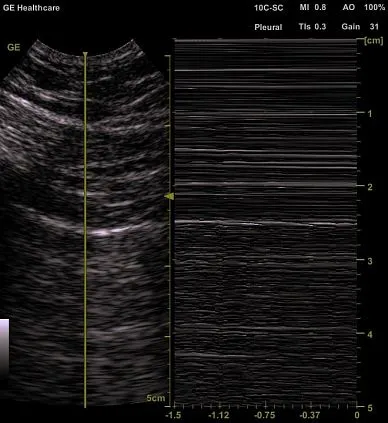 Клинические изображения GE Venue 50 аппарат УЗИ портативный