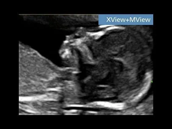 Клинические изображения УЗИ аппарат Esaote MyLab Seven