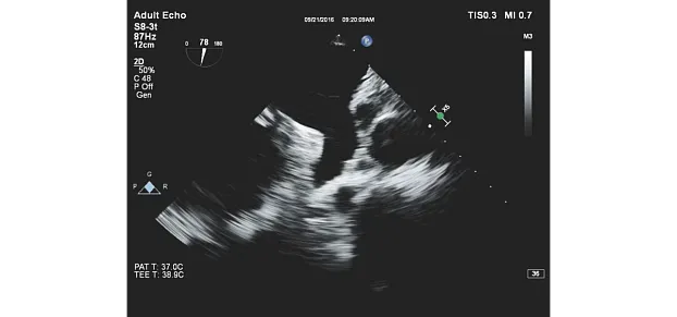 Клинические изображения Philips EPIQ CVx ультразвуковой аппарат