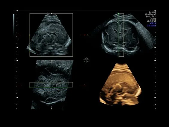 Клинические изображения Ультразвуковая диагностическая система GE Voluson E10