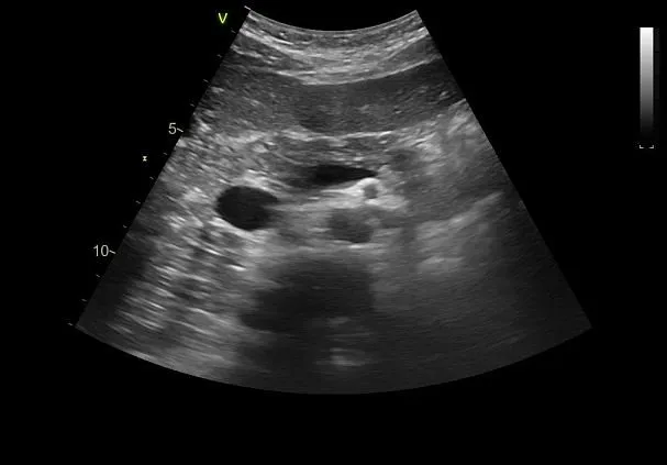 Клинические изображения Ультразвуковая диагностическая система GE HealthCare Vivid T8